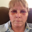 Post op day 2, started arnica.