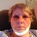 Post op day 4. This shows my chin strap I made, the one the Dr had was so uncomfortable, wasnt wearing it
