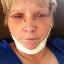 Post op day 6, bruising almost gone with arnica. Swelling a lot better,