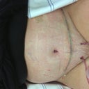 3 days post op At dr office. Sorry no underwear yet