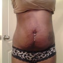 Pre op. A little worried about skin tightening but dont want a tummy tuck