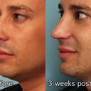 before and 3-weeks after surgery day. Rhinoplasty with lower blepharoplasty (transconjunctival, no skin removed)