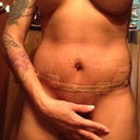 Swelling swelling go away come back another day, and on top PMS, lucky me lol post op 11 not much change