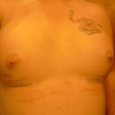 8 days post op