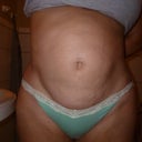 10/18/12: Post op pic 1, front