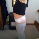 2 Days post op