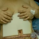 post op