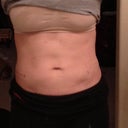 1.5 weeks after sides.  5 weeks after upper stomach. Line is pretty much gone, and now my lower stomach looks huge in comparison!