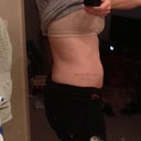 1.5 weeks after sides.  5 weeks after upper stomach. Line is pretty much gone, and now my lower stomach looks huge in comparison!
