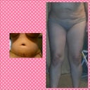 b4-after ....this pic is 2 weeks p/op still really swollen