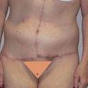 This 53 Year Old Woman Wanted To Have A Body Lift 