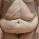 This 53 Year Old Woman Wanted To Have A Body Lift 