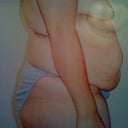 day of surgery ugh!