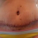 13 days post-op. Scabs are starting to fall off!