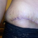 you can see the stretch marks coming up from my scar and still around to my sides. :( depressing.