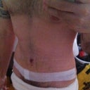 Post Op - Day 13 - After my first PO visit and with the new tape.