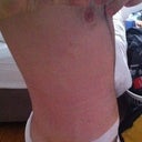 Post Op - Day 13 - After my first PO visit and with the new tape.