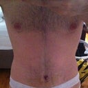 Post Op - Day 13 - After my first PO visit and with the new tape.