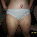 post op 9 days. I am kind of standing crooked, that's why my bb looks not centered. lol