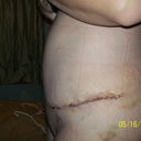 post op 9 days I know I am still very swollen!