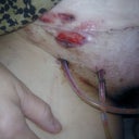 Blisters from the tape