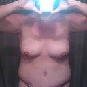 Week 2 plenty of swelling plus asymmetry from the infection on my right side.
