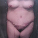 lots of swelling in my right side and upper right thigh from the infection.