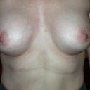 One month post op