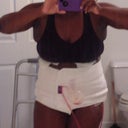 Here is a front view 3 days post op. It was hard for me to stand long unassisted, so I know it is not very clear. However, you can see my improved boobies!