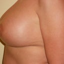 Side Boob Left-with implant