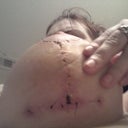incision sites