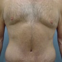47 Year Old Male Tummy Tuck
