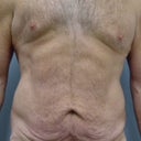 47 Year Old Male Tummy Tuck
