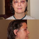 24 hrs. post-op – looking pretty scary but feeling no pain. You can see the staples just above my ear.