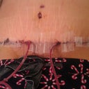 Post Op day #4