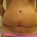 2 weeks PO close-up