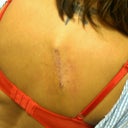 can see how close to my spine the scar