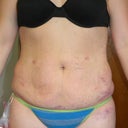 Post Op Day 2- Front View
