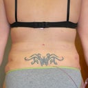 Post Op Day 2- Back View