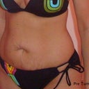 Pre surgery. I wish I had a picture of my lower abs below my bathing suit..this is where you can see more of the loose skin.