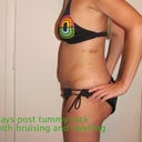 1 wk post TT w/bruising and swelling