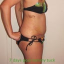 1 wk post TT