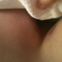 I don't know if you can see the bruise on the right breast.