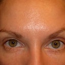 Uneven eyebrows