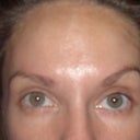 Uneven eyebrows