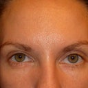 normal expression and you can see how the eyelids are uneven and the one eye is bigger than the other