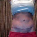 3 months post op