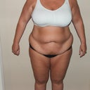 2 days prior to surgery