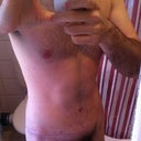 Post Op - Day 23 - After my second PO visit and with silicone tape.