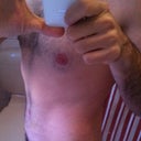 Post Op - Day 23 - After my second PO visit and with silicone tape.
